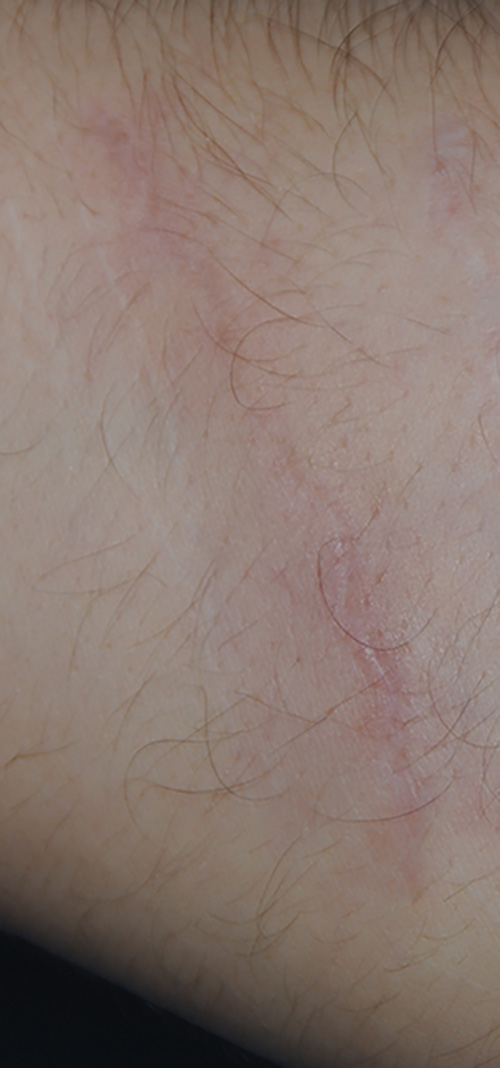 Self Harm Scar Treatment with Excision Close Up After