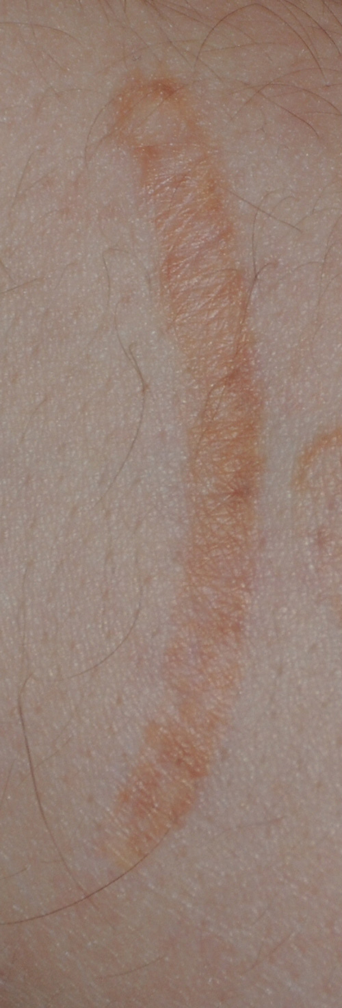 Self Harm Scar Treatment with Excision Followed by Co2 Laser Close Up Before