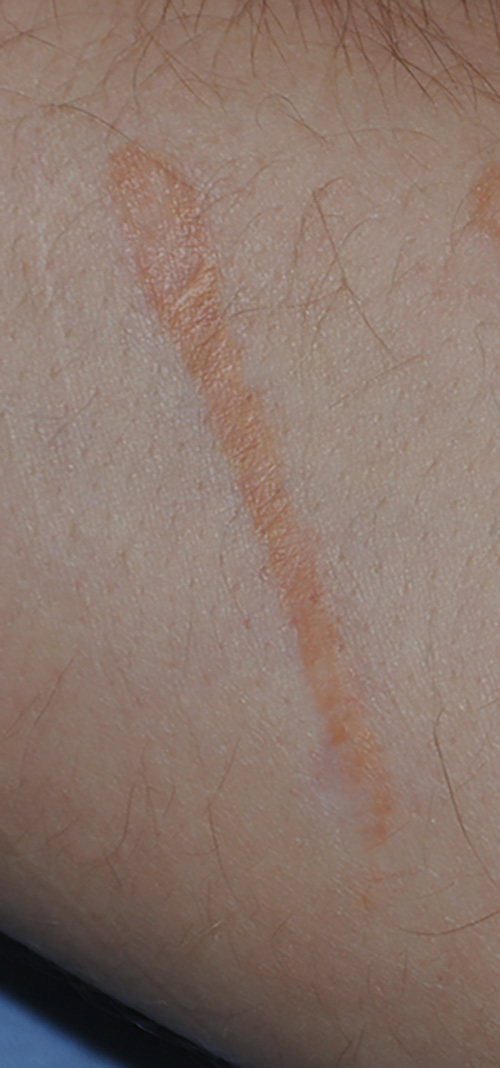 Self Harm Scar Treatment with Excision Close Up Before