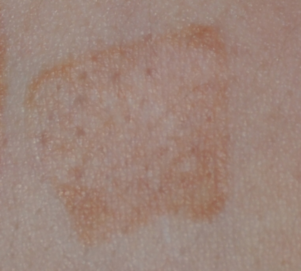 Co2 Laser of Self Harms Scars Close Up Before