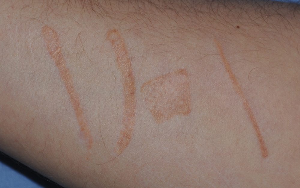 Self Harm Scar Treatment with Excision and co2 Laser Before