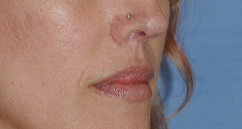 After Buffalo Gull Wing Lip Lift and Lip V-Y Advancement Extreme Close Up View