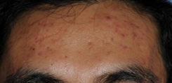 Acne Skin Care Before and After Pictures