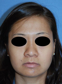 Asian | Ethnic Rhinoplasty