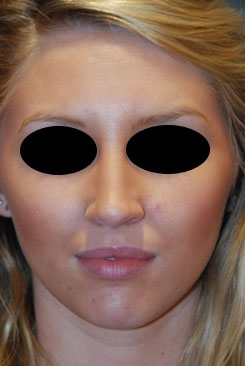 Large Long Nose Rhinoplasty