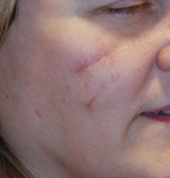 I Tried Fractional CO2 Laser Treatment, and I'm Amazed by the Results — See  Photos