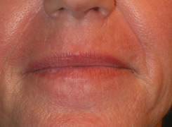 Laser resurfacing after