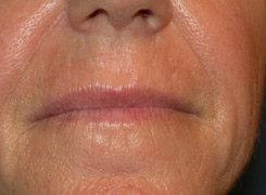 Laser resurfacing before