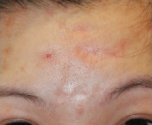 Pock Mark Acne Scar Treatment