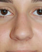 Bulbous Tip Rhinoplasty