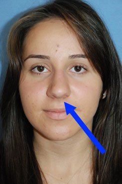 Nasal Tip Refinement Rhinoplasty