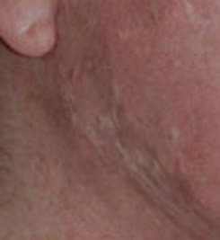 Elevated White Hypopigmented Acne Scars