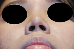 Wide-Nose-Nostril -Rhinoplasty