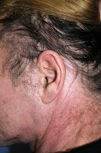 'After Face and Necklift incisions in front and behind the ear'