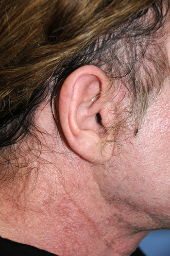 After Face and Necklift incisions in front and behind the ear