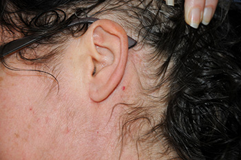 Images of Incision 6 months after Neck Lift