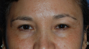  Fractional Laser Eyelid Lift Before Photo Close Up