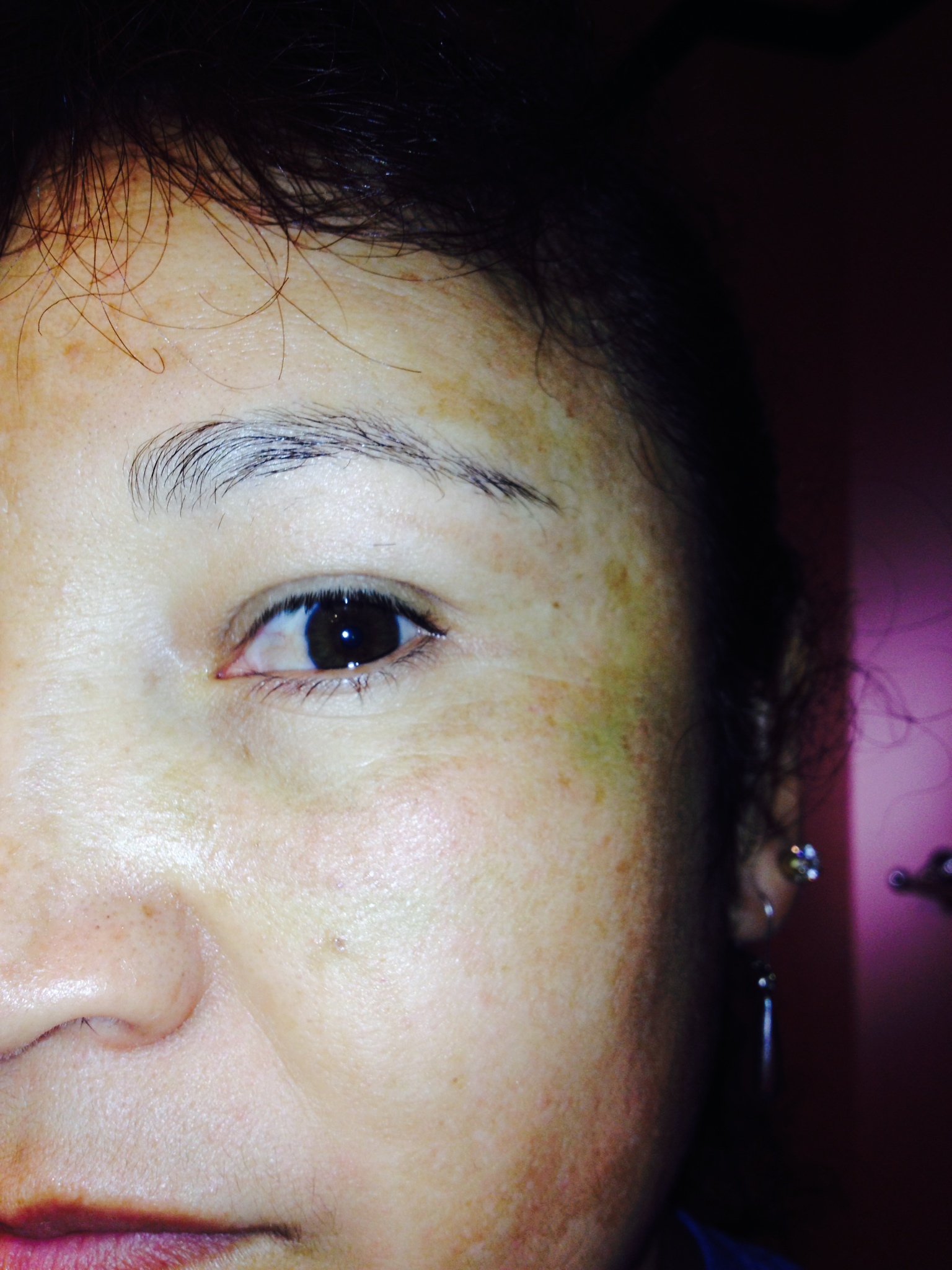 This is Day 10 after the Fractional Laser Eye Lift Left Oblique