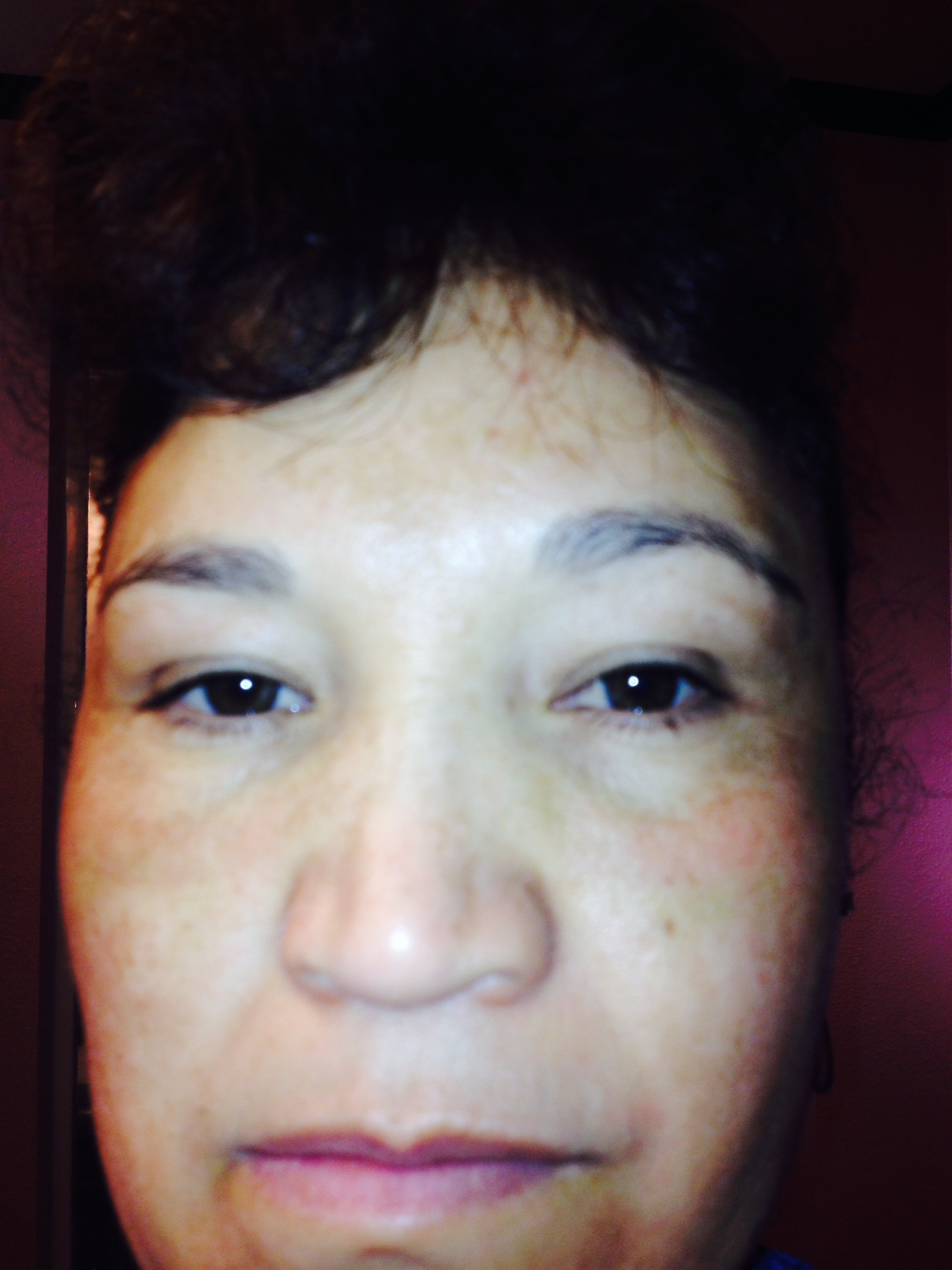 This is Day 10 after the Fractional Laser Eye Lift