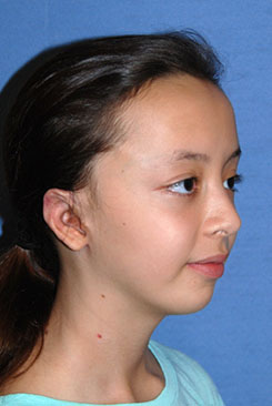 Cup Lop Constricted Ear After Otoplasty Right Oblique